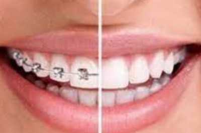(LLLT)Low-level laser therapy in acclerating orthodontic tooth