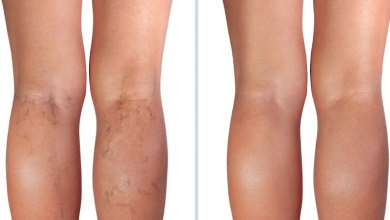 vein Treatment clinic in New York