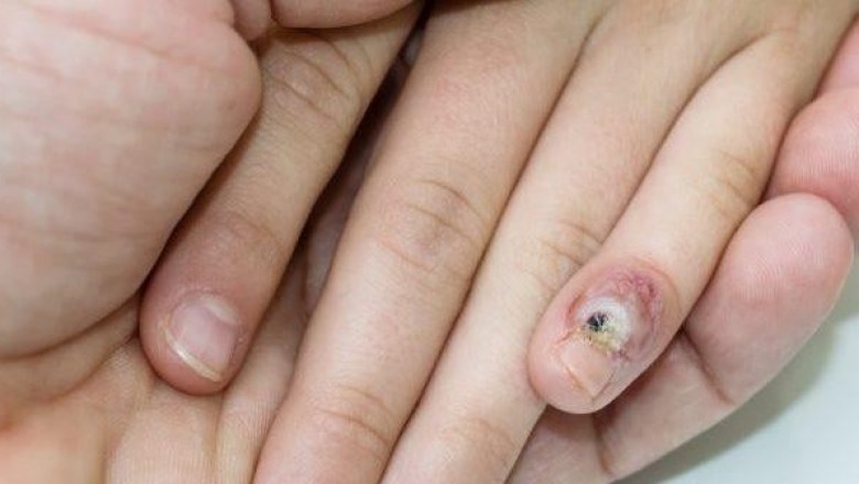 Human Papillomavirus (HPV) and Cytomegalovirus (CMV) Therapeutics Market Forecast Made Available By Top Research Firm 2026