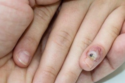 Human Papillomavirus (HPV) and Cytomegalovirus (CMV) Therapeutics Market Forecast Made Available By Top Research Firm 2026