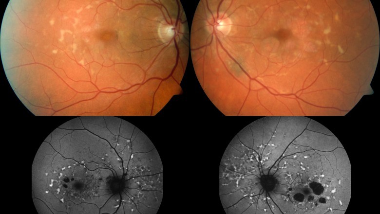 Stargardt Disease Therapeutics Market Growth Forecast from Worldwide