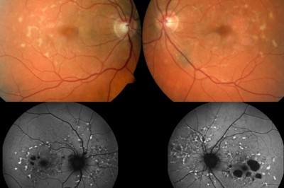 Stargardt Disease Therapeutics Market Growth Forecast from Worldwide