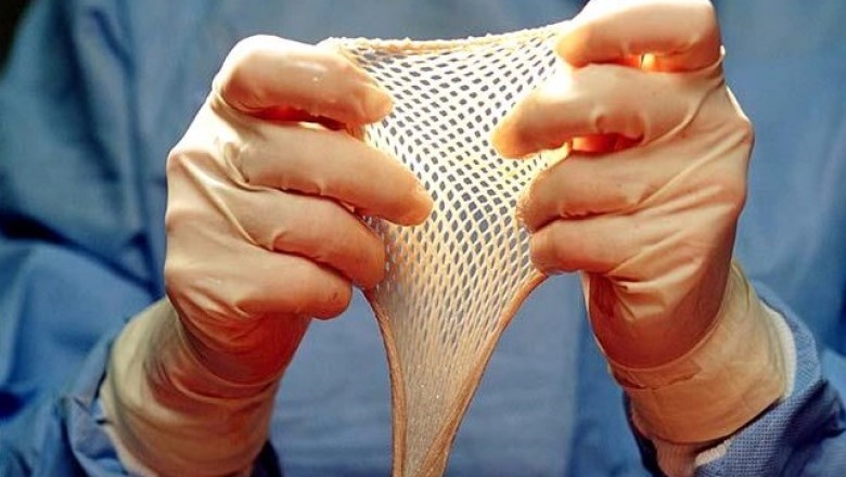 The dermal regeneration template is a two-layered skin regeneration advanced system.