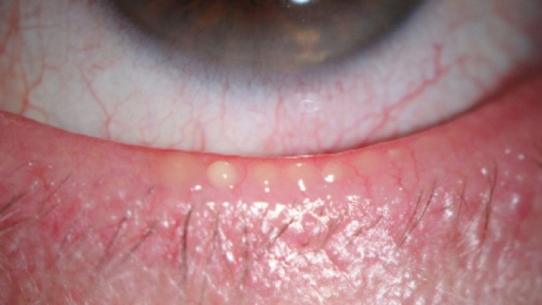 U.S. Meibomian Gland Dysfunction Market Size, Growth Opportunities, Trends, Key Players And Forecast To 2020-2030