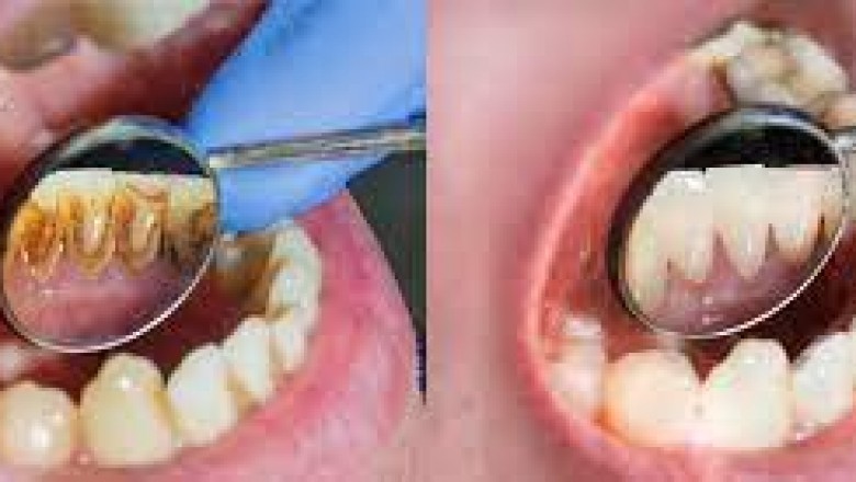 Why professional teeth cleaning is important?