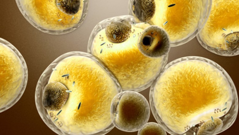 Lysosomal Acid Lipase (LAL) Deficiency Treatment is currently limited to control of cholesterol levels and to prevent premature atherosclerosis