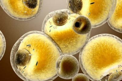 Lysosomal Acid Lipase (LAL) Deficiency Treatment is currently limited to control of cholesterol levels and to prevent premature atherosclerosis