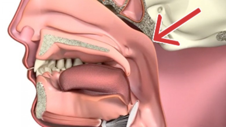 Nasopharyngeal Carcinoma Treatment Is Used To Treat This Type of Rare Cancer That Occurs Mainly In the Neck and Head and Has A Lot of Treatment Options