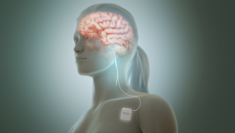 Vagus Nerve Stimulators; Help Stimulate the Vagus Nerve with Electrical Impulses