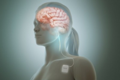 Vagus Nerve Stimulators; Help Stimulate the Vagus Nerve with Electrical Impulses