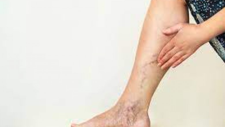 What are the Benefits of Compression Socks in Dealing with the Varicose Veins?