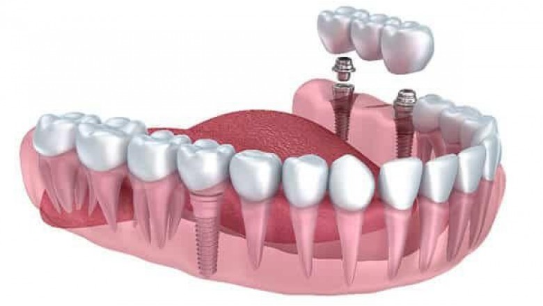 Intramucosal Implants Market Size, Trends, Shares, Insights and Forecast – 2018-2026