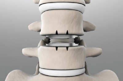 Patients who undergo Total Disc Replacement surgery typically go back to work a few days following the procedure