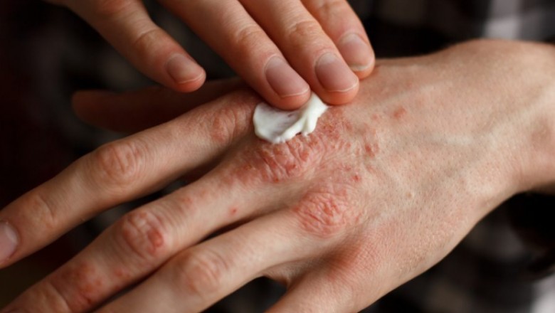 pruritus one of those skin conditions which can be helped by using LDN