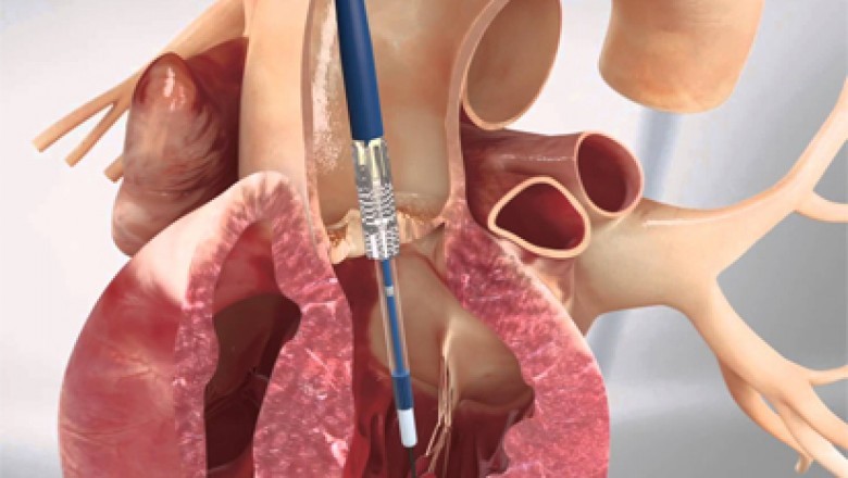 Transcatheter Aortic Valve Implantation (TAVI) has become significantly crucial in minimally invasive heart procedures