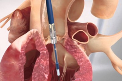 Transcatheter Aortic Valve Implantation (TAVI) has become significantly crucial in minimally invasive heart procedures