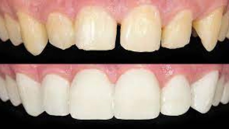 What is the Process of Dental Bonding?