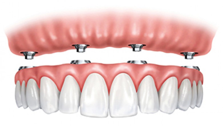 All on 4 Dental Implants Cost In Hyderabad | All on 4 Dental Implants Cost In India