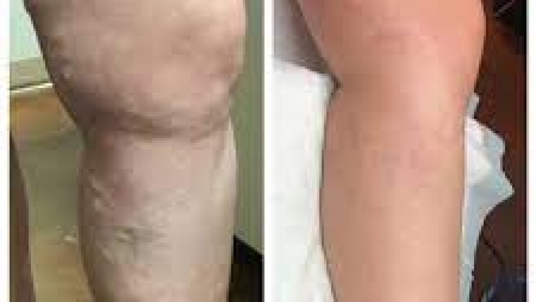 5 Questions to Ask Before You Choose a Vein Treatment Center