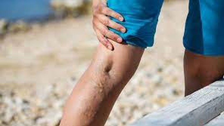 New Jersey Spider Vein Treatment Center Near Me