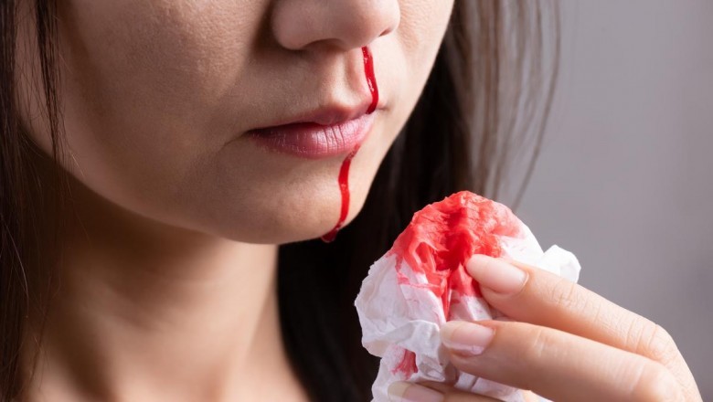 Allergies Are Known To Cause Epistaxis Due to Congestion in Nose and Throat