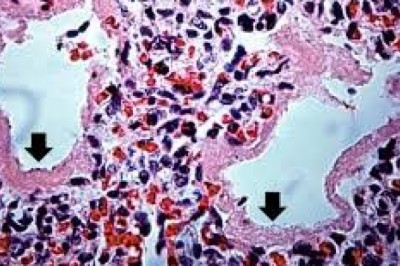 Neonatal Respiratory Distress Syndrome Treatment  Market – Growth, Latest Trend & Forecast 2027