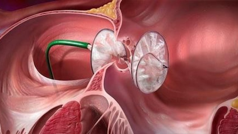 PFO Closure Devices Market Size, Trends, Shares, Insights and Forecast – 2018-2026