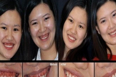 Teeth Under Veneers
