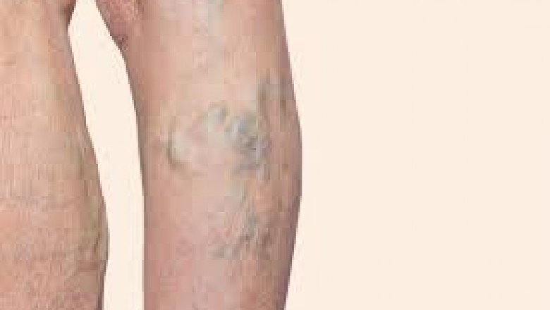 Varicose Veins Management: Learn more about Compression Hose, Stockings & Socks.