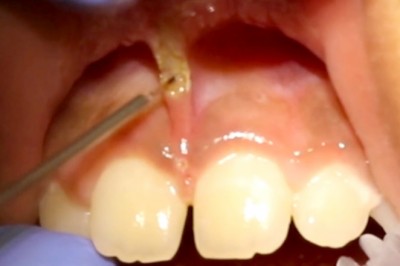 Soft tissue Laser Applications in Pediatrics