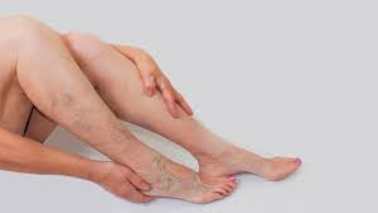 California Veins Treatment Near Me