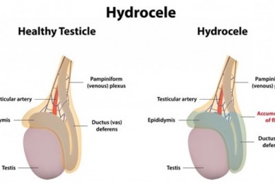 How does hydrocele affect infants and adults?