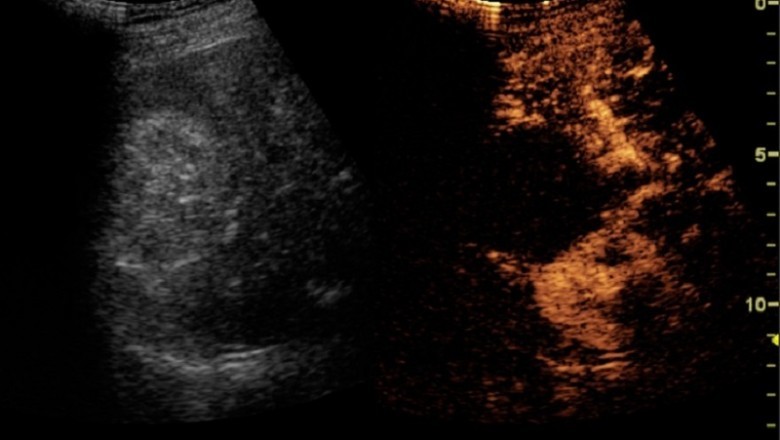 Microbubble Contrast Media expected to gain market growth at a potential rate of 25.40%