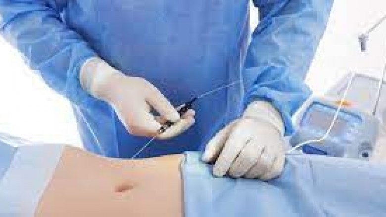 Best Laser Liposuction in Houston