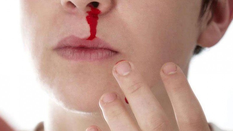 Epistaxis is due to nasal and throat congestion as a result of allergies