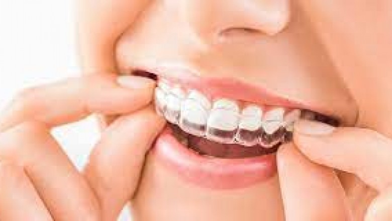 Porcelain Veneers Before And After