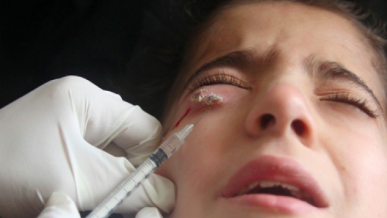 Drug choice, host immune response, and parasite strain are important components in leishmaniasis treatment effectiveness
