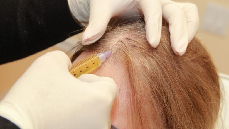 PRP Treatment