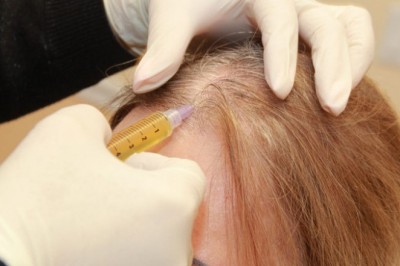 PRP Treatment