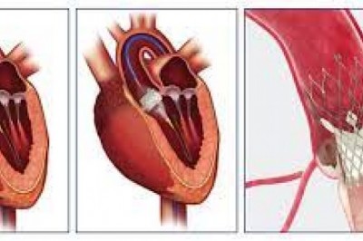 Transcatheter Heart Valve Replacement is a minimally invasive procedure for replacing a narrowed aortic valve that is unable to open properly.