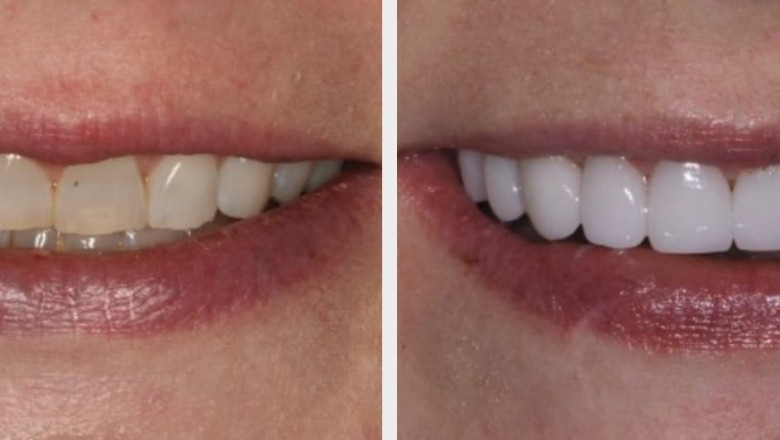 Cosmetic Dentistry in Houston, TX
