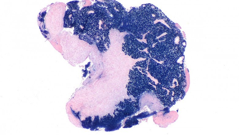 This type of rare cancer, which often occurs in the neck and head, offers a number of treatment options, such as Nasopharyngeal Carcinoma Treatment.