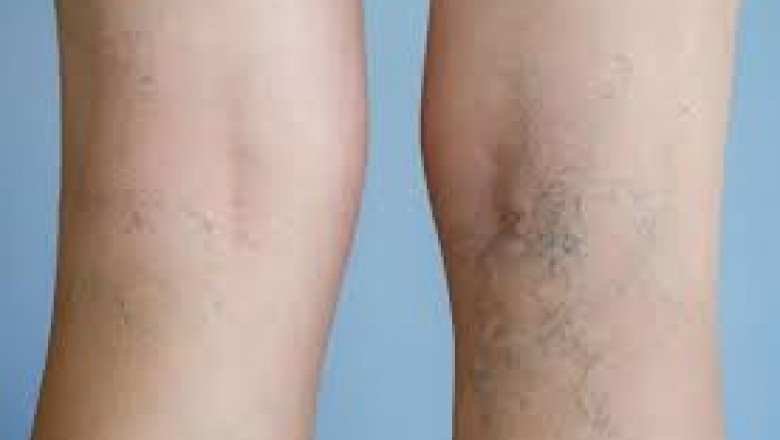 Varicose Veins: Why Women Are More Likely To Have Them?