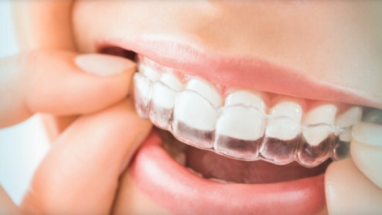 Dental Scan Night Guards, No Impressions