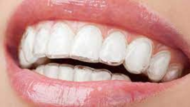 Same-Day Veneers; Benefits, Procedure, AfterCare
