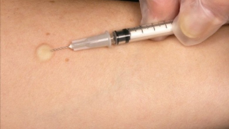Tuberculosis Vaccine invention provides another example of mankind's ability to find inventive solutions to health problems