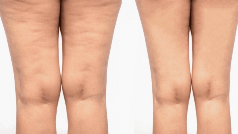 Cellulite Treatment Market Size, Share, Outlook, and Opportunity Analysis, 2019– 2027