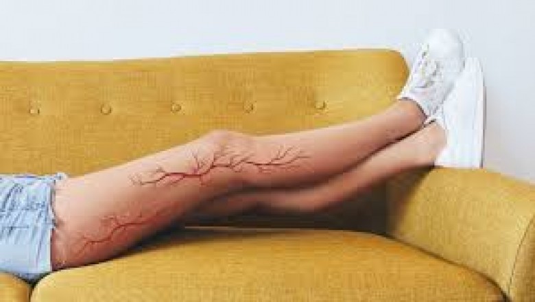 What is the relationship between varicose veins and pregnancy?