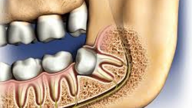 Wisdom Teeth Removal: What You Need To Know?