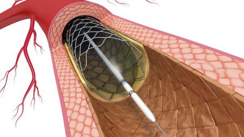 During the forecast period (2017 - 2025), the global drug eluting stents market is projected to grow at a strong CAGR of 4.7%.
